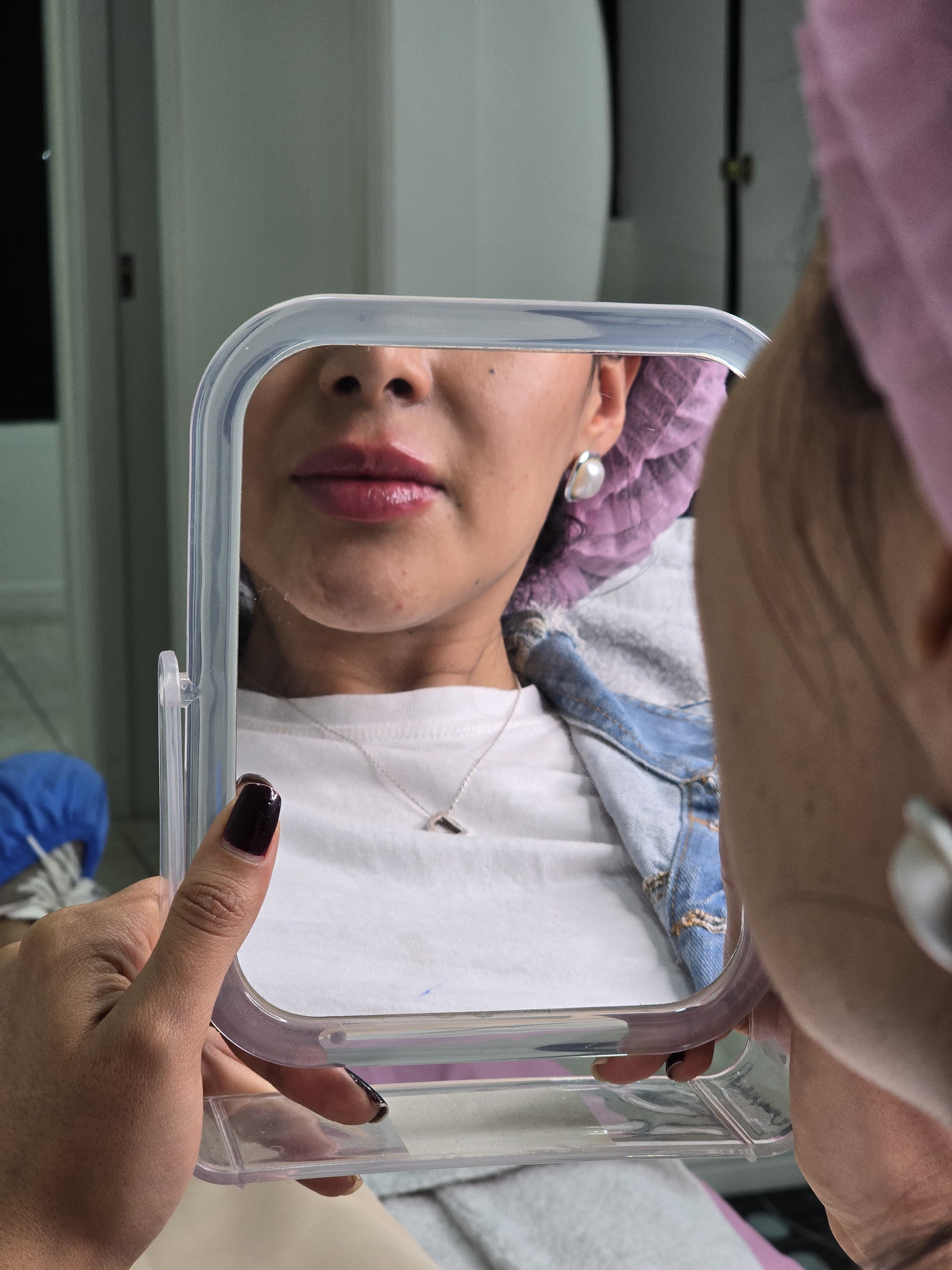Relleno de Labios